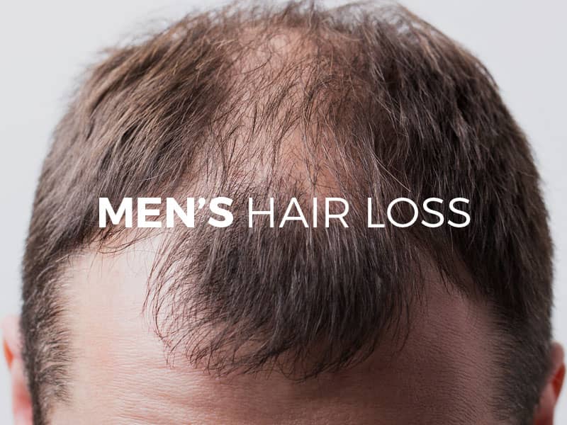 Men’ Hair Loss