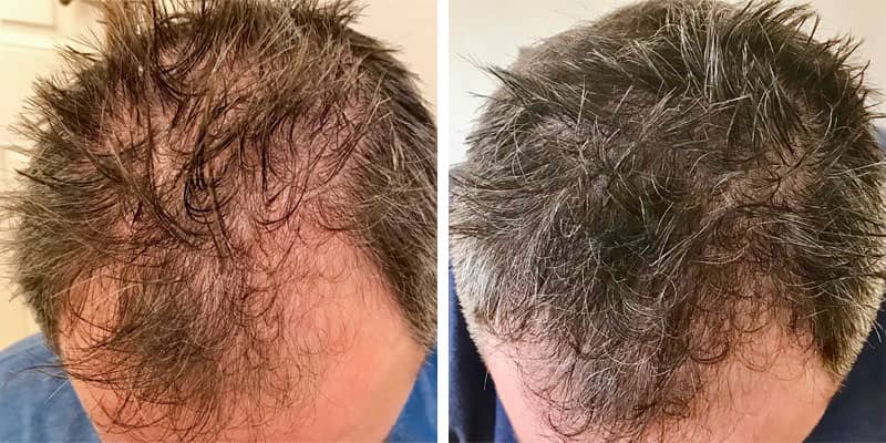 Before and after men’s hair loss