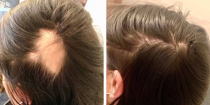 Before and after women’s hair loss