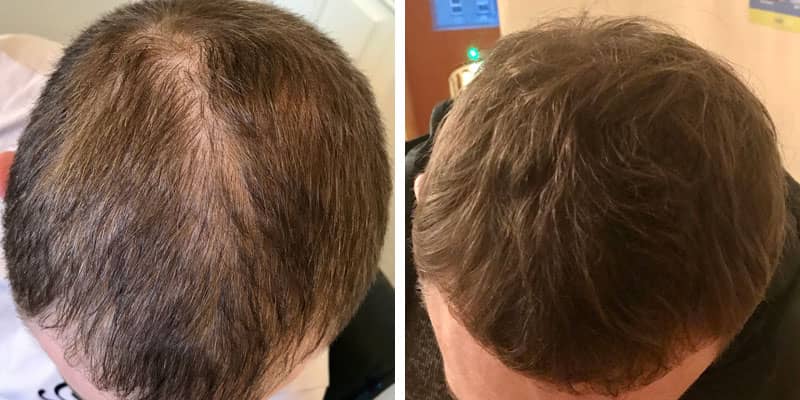 Before and after men’s hair loss