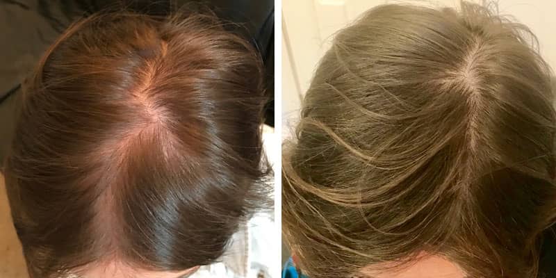 Before and after women’s hair loss