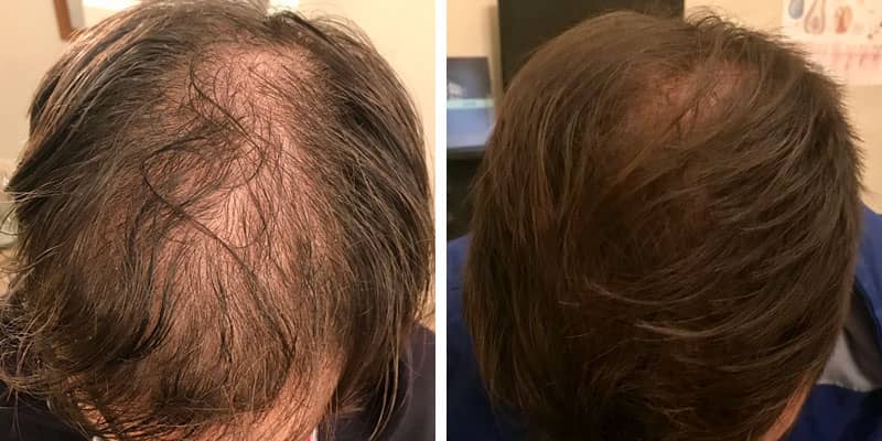 Before and after men’s hair loss