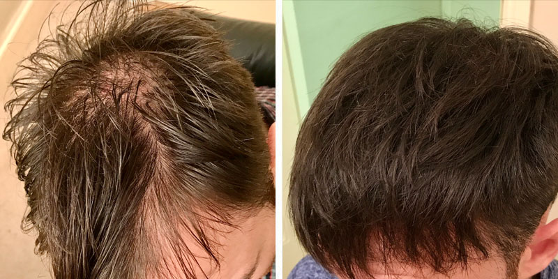 Before and after men’s hair loss