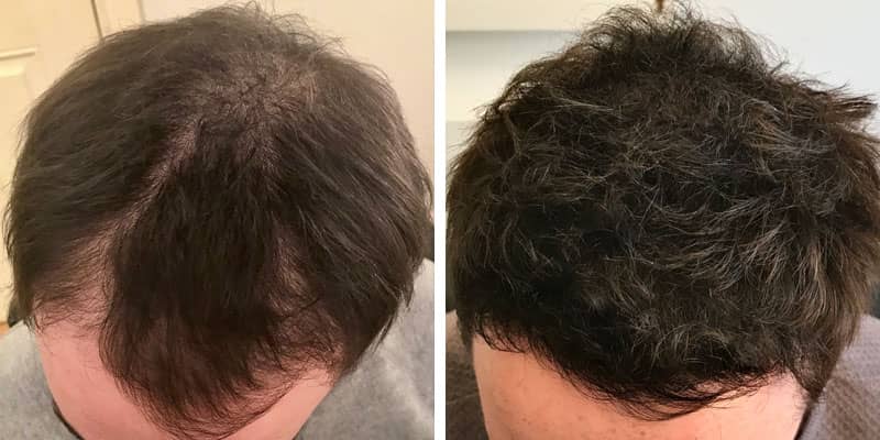 Before and after men’s hair loss