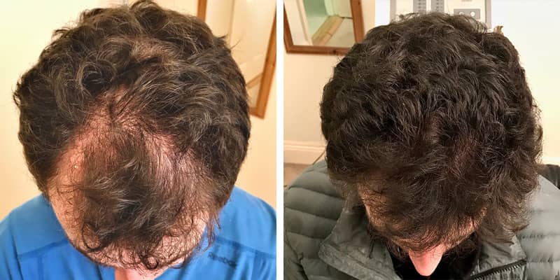 Before and after men’s hair loss