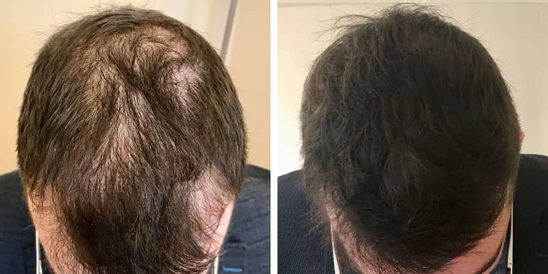 Before and after men’s hair loss