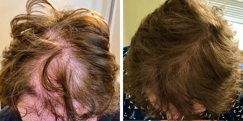 Before and after women’s hair loss