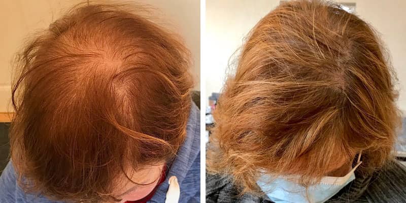 Before and after women’s hair loss