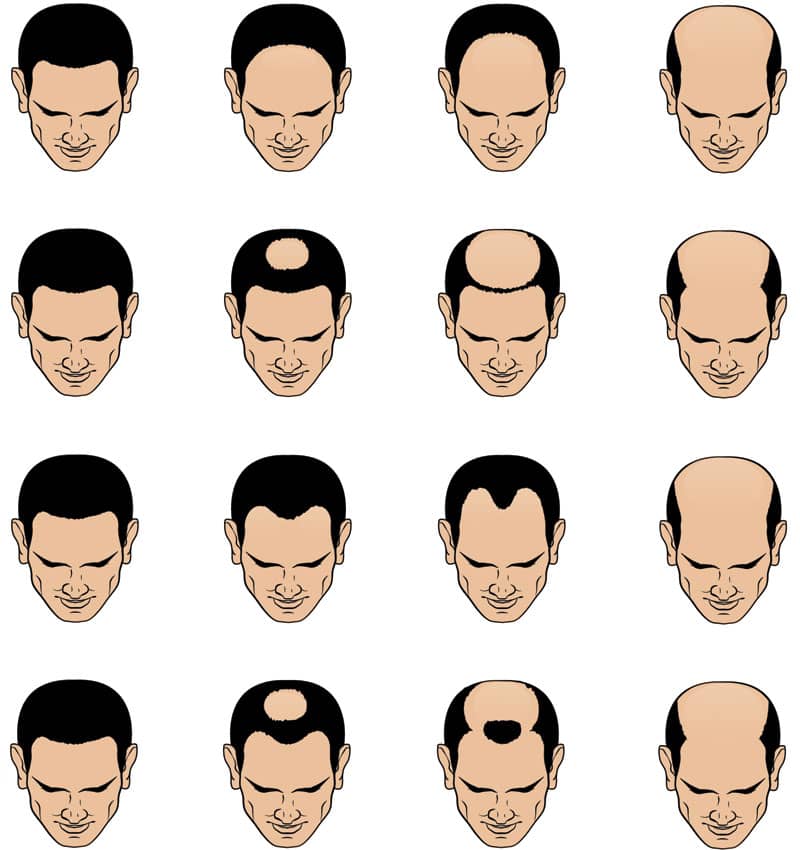Illustration of male pattern baldness