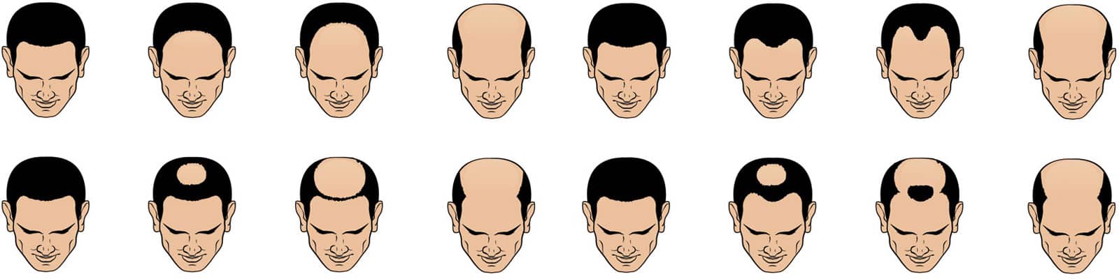 Illustration of male pattern baldness
