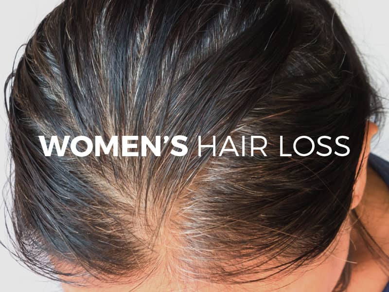 Women’s Hair Loss