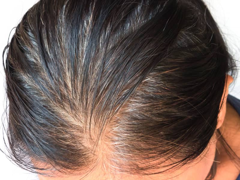 Woman suffering hair loss
